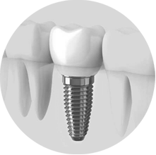 Dental Implants